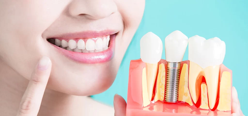 Are Dental Implants worth it