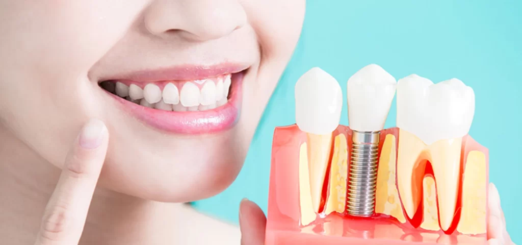 Should I Consider Dental Implants?