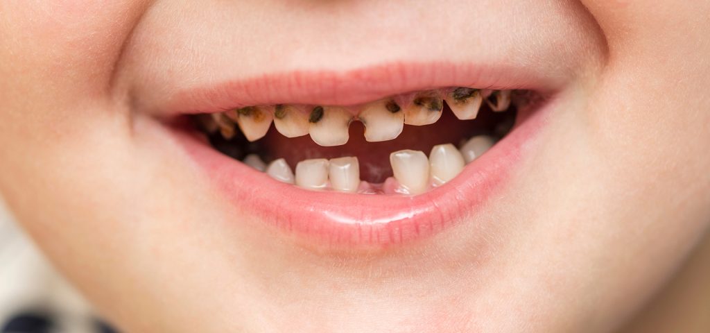 Dentist checking a child's teeth for early signs of tooth decay