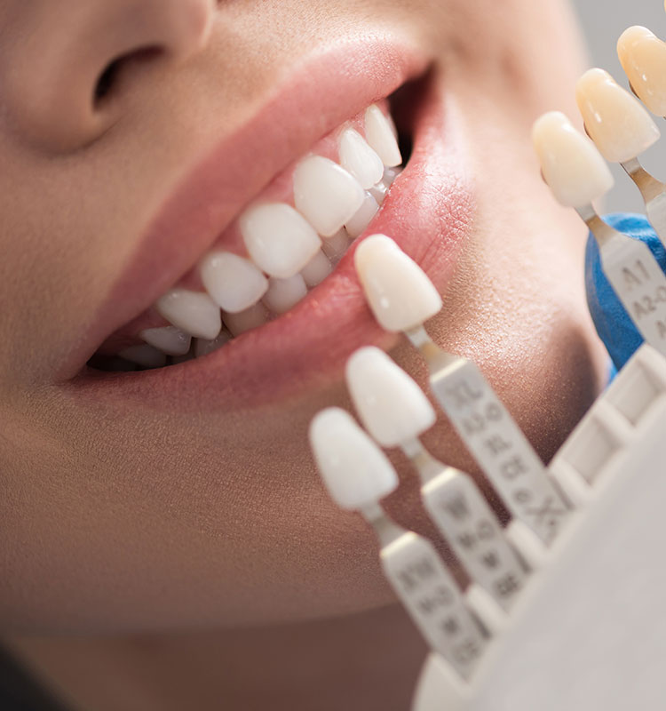 dental crown for a patient at Tulip Smile
