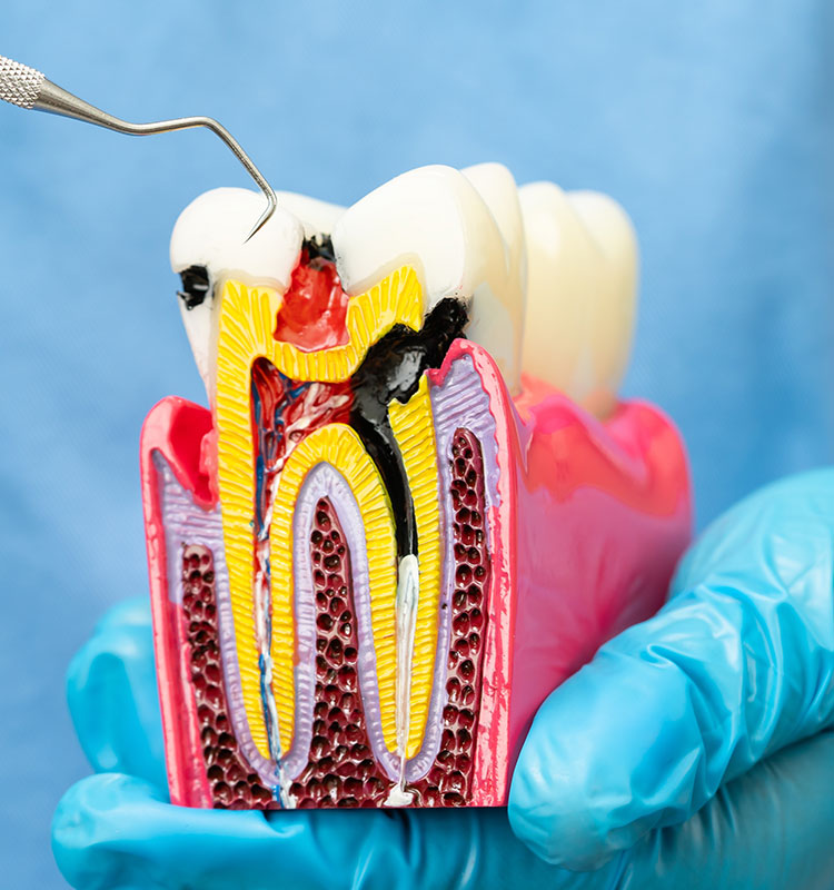 Root canal treatment at Tulip Smile
